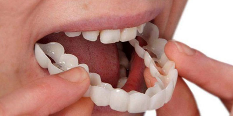 مزیت انجام لمینت دندان چیست ؟ 
